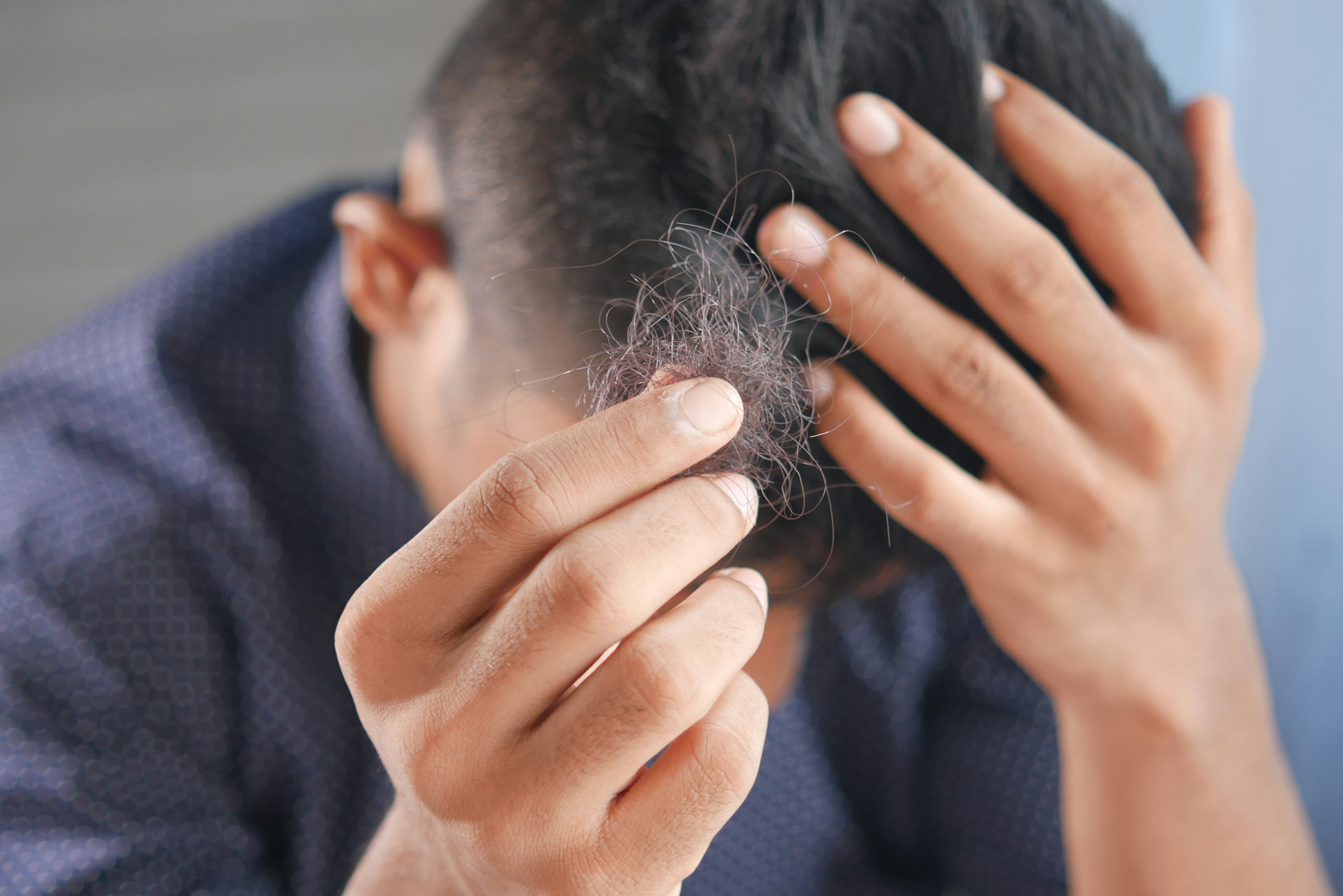 Gubitak kose (alopecija): što je normalno, a što za liječenje