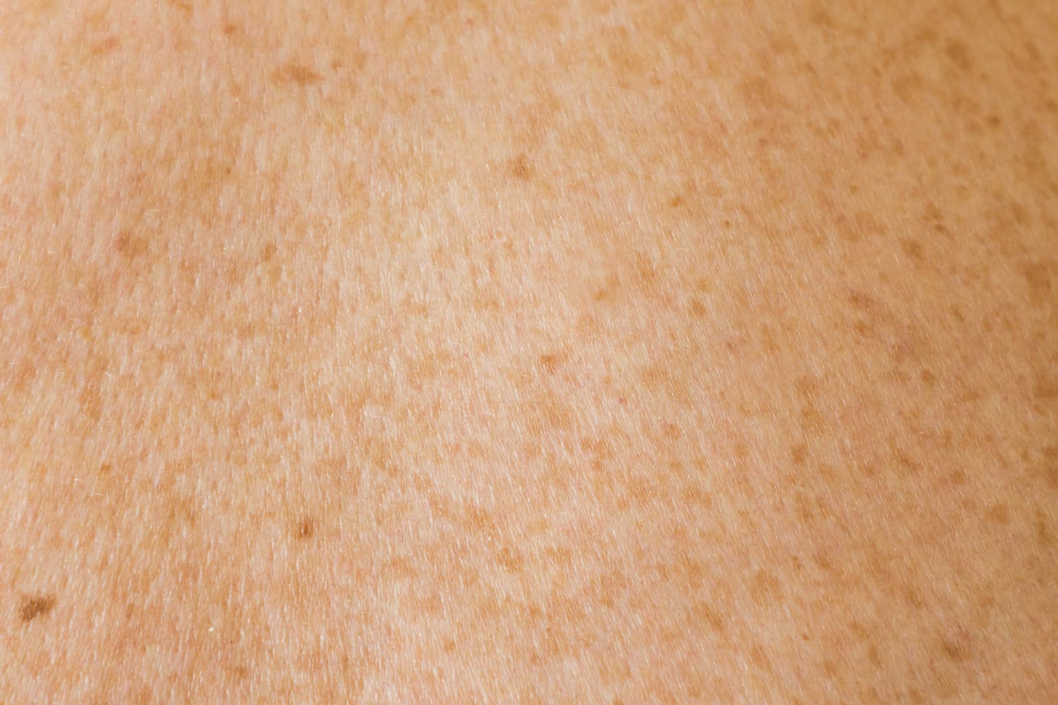 ABCDE pravilo i dalje vrijedi: kada se madež treba pokazati dermatologu