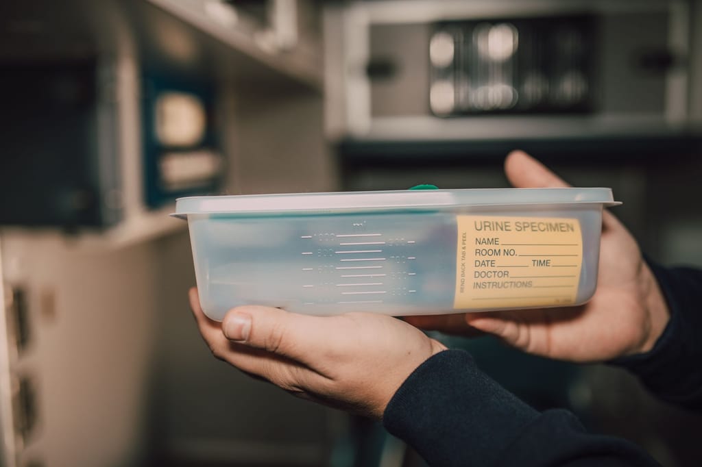 Laboratorijska pretraga urina otkriva rane znakove