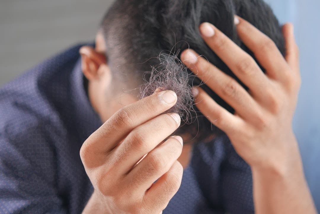 Gubitak kose (alopecija): što je normalno, a što za liječenje